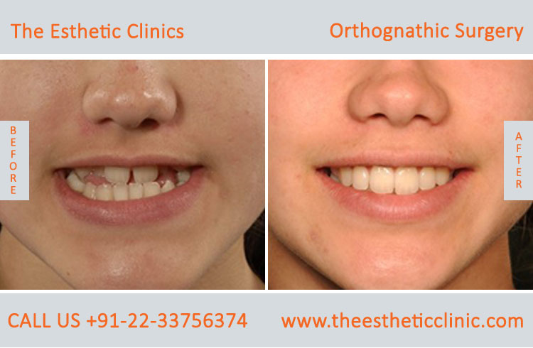 Orthognathic Surgery, Jaw Correction Surgery before after photos in mumbai india (7)